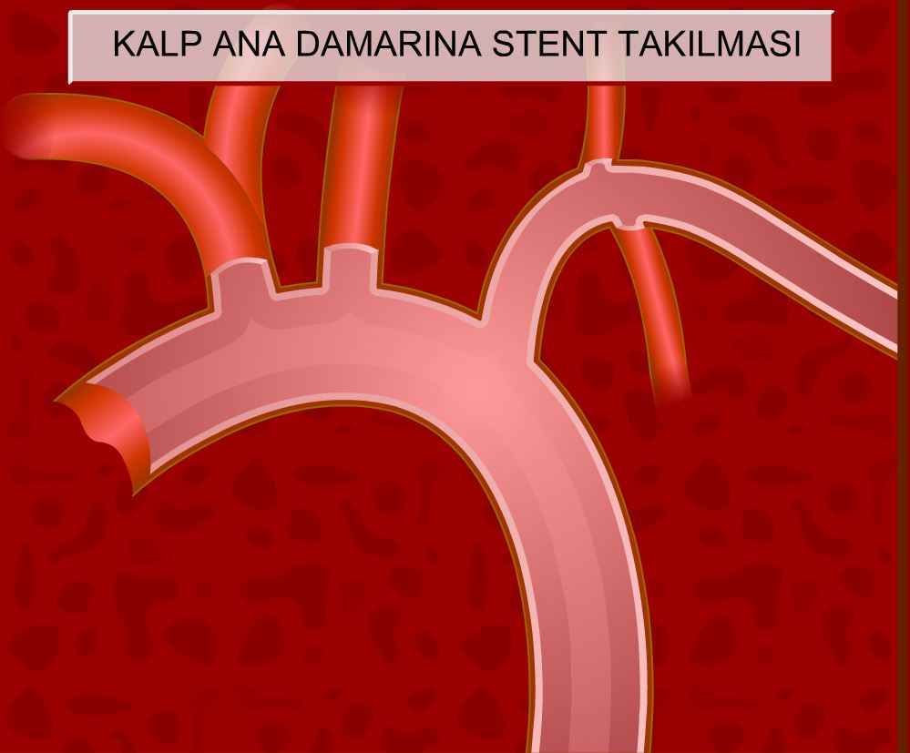 Kalp Damar Tkankln Almas (Stent taklmas))