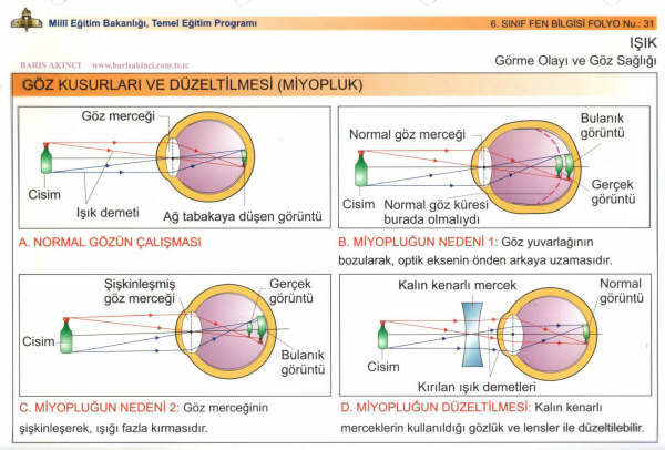 Gz Kusurlarnn Dzeltilmesi Miyopluk